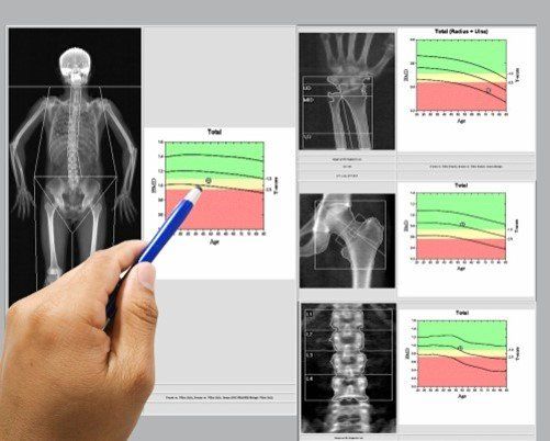 A hand pointing at a bone density scan displaying X-rays and graphs indicating bone health levels.
