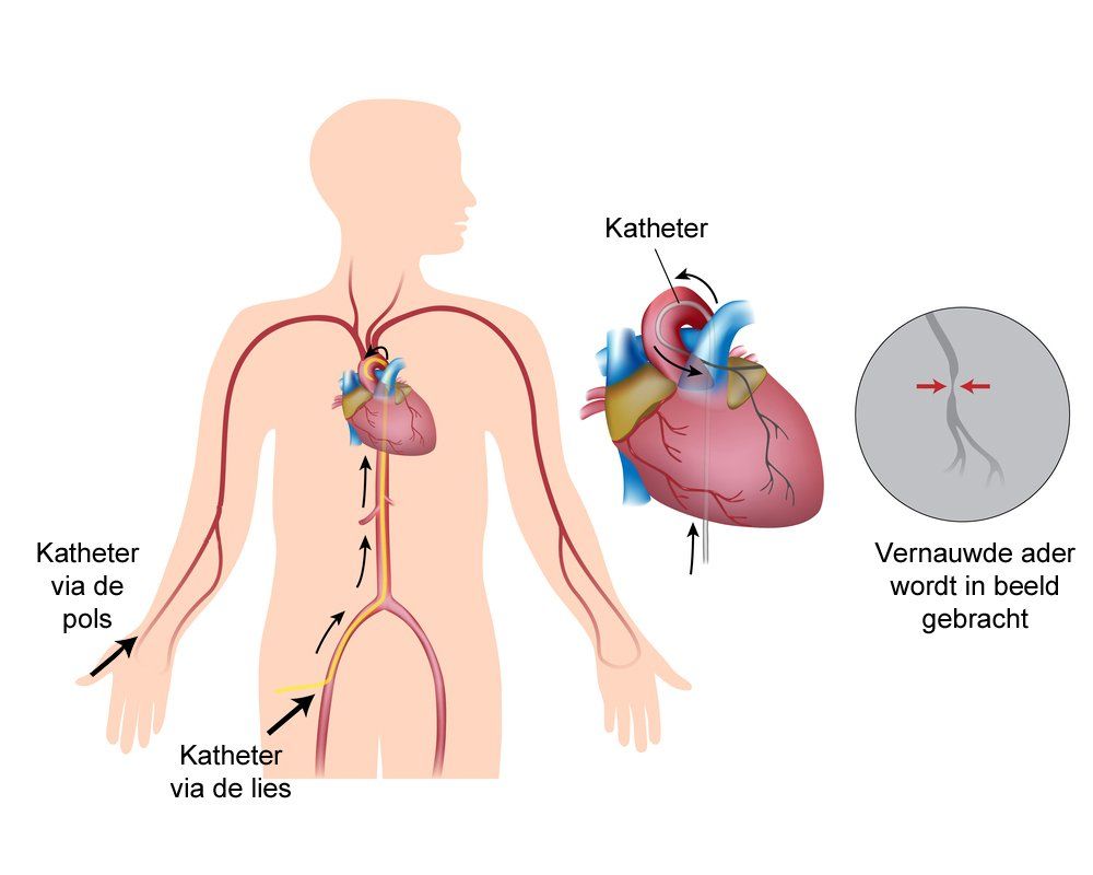Diagram van het plaatsen van een katheter in aders en slagaders om het hart te bereiken, met weergave van de bloedstroom en de katheterroutes.
