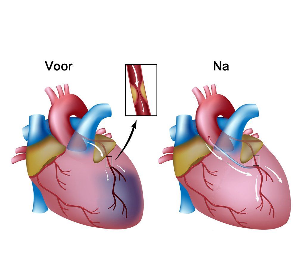 Illustratie van een hart voor en na een operatie, waarop de verbeterde bloedstroom in een vernauwde slagader te zien is.