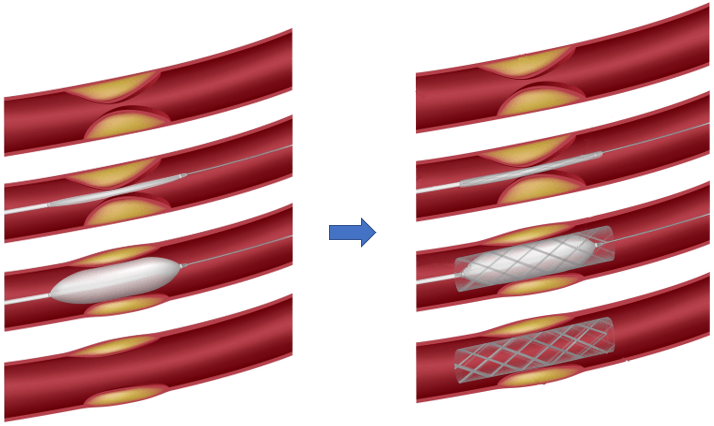 Een medisch diagram van voor en na, met gelaagde rode bloedvaten en een blauwe pijl naar rechts die de vorming van een bloedstolsel laat zien.