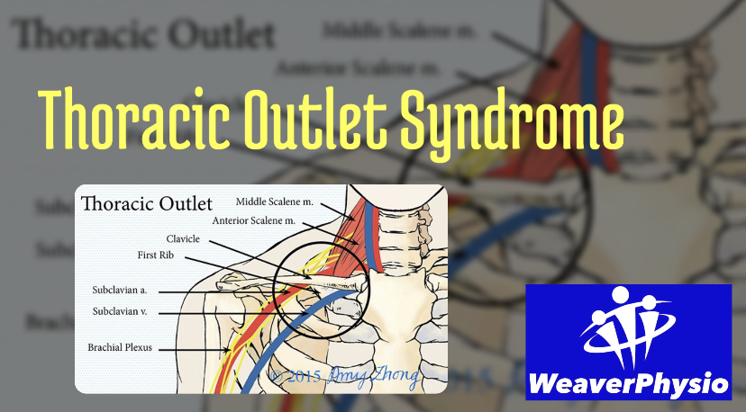Thoracic Outlet Syndrome (TOS)