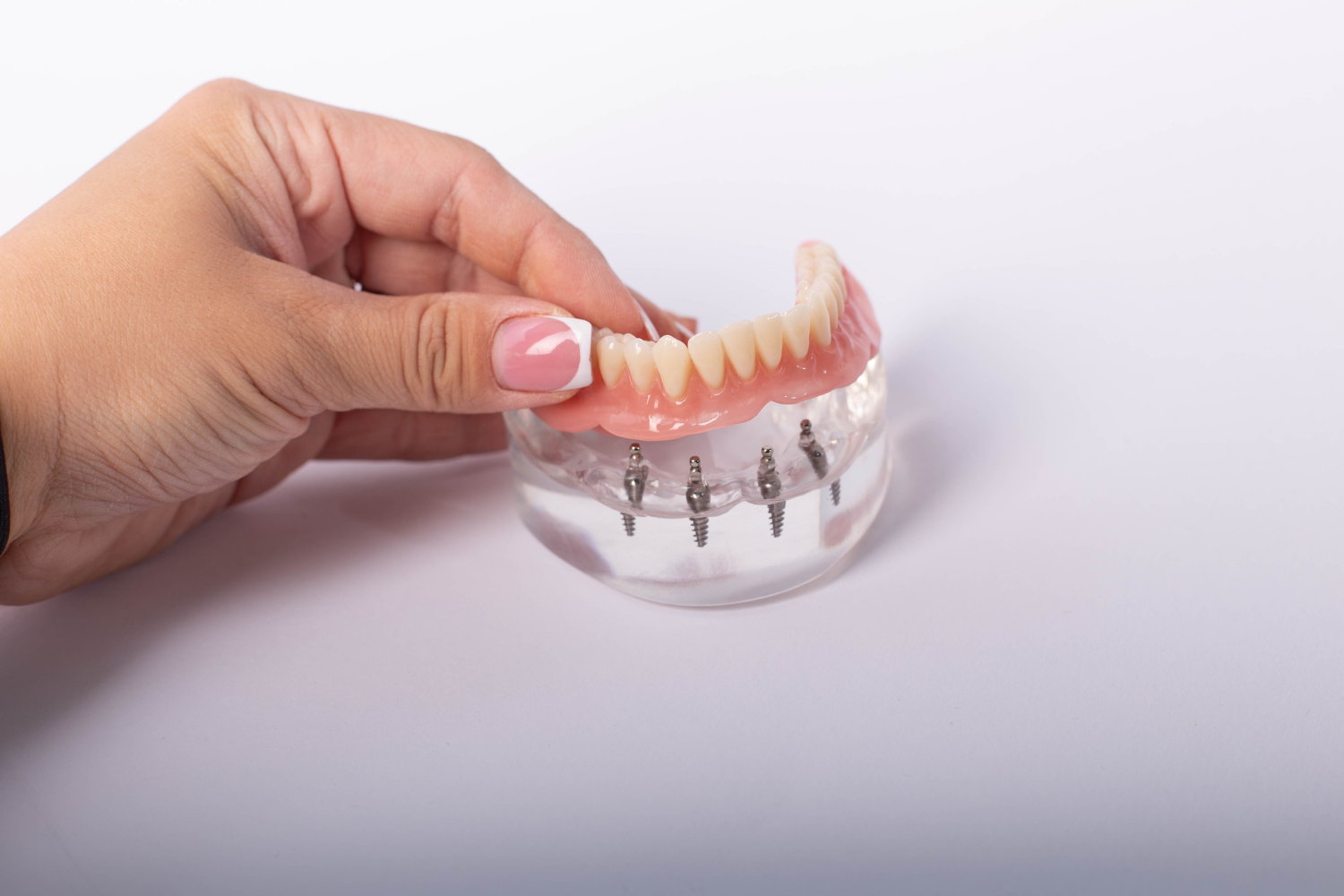 A hand holds a dental bridge model with artificial teeth positioned above metal implant abutments in a clear base.