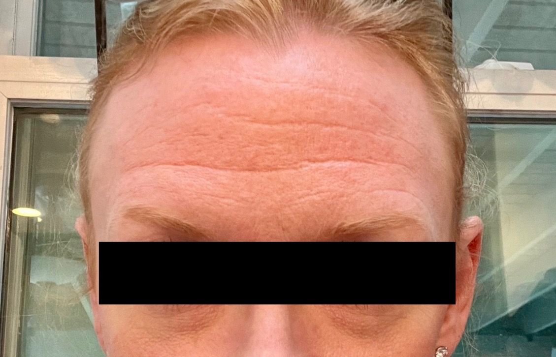 Forehead with horizontal wrinkles and a black bar obscuring the eyes.