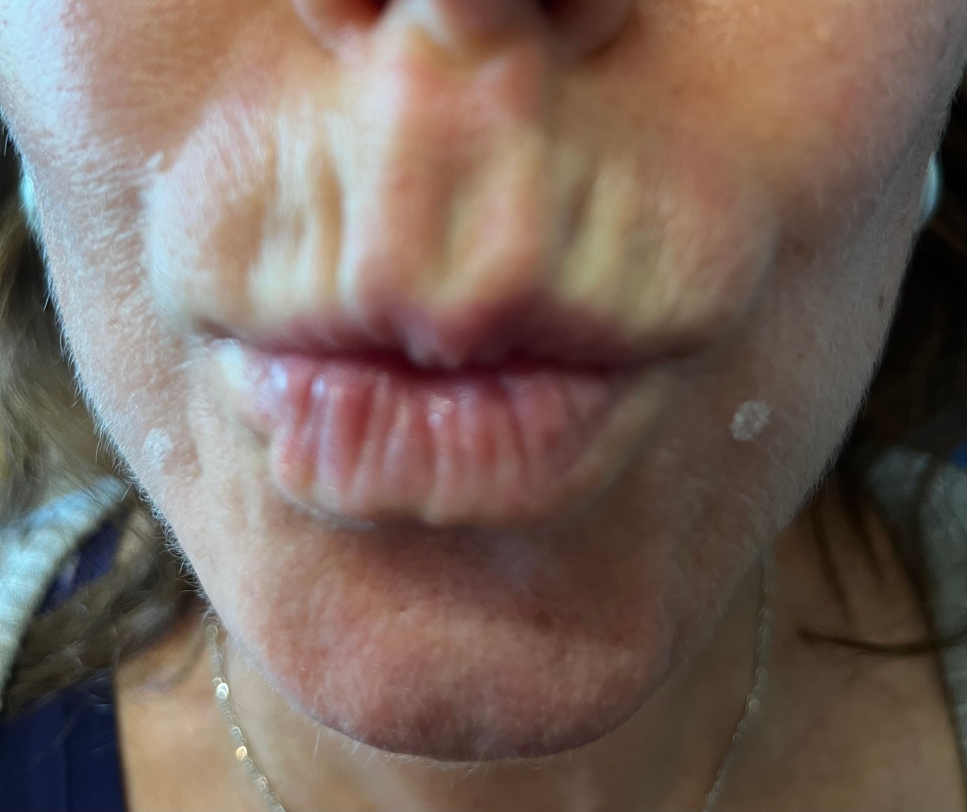Close-up of a person's puckered lips. Two small, white dots are visible on the skin.