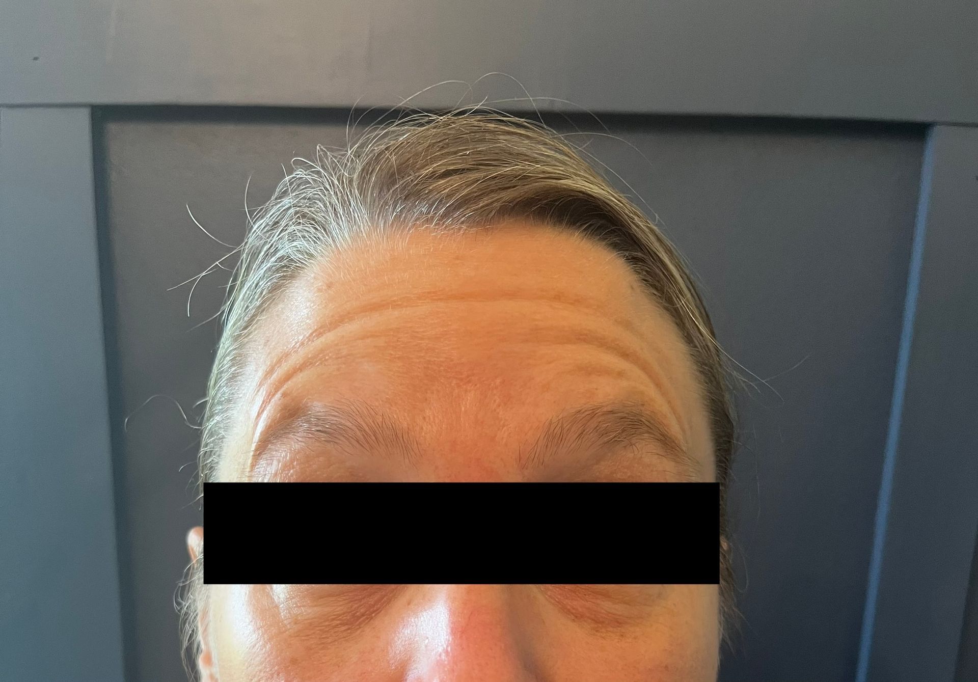 Forehead with wrinkles and receding hairline; eyes are blocked by a black rectangle.