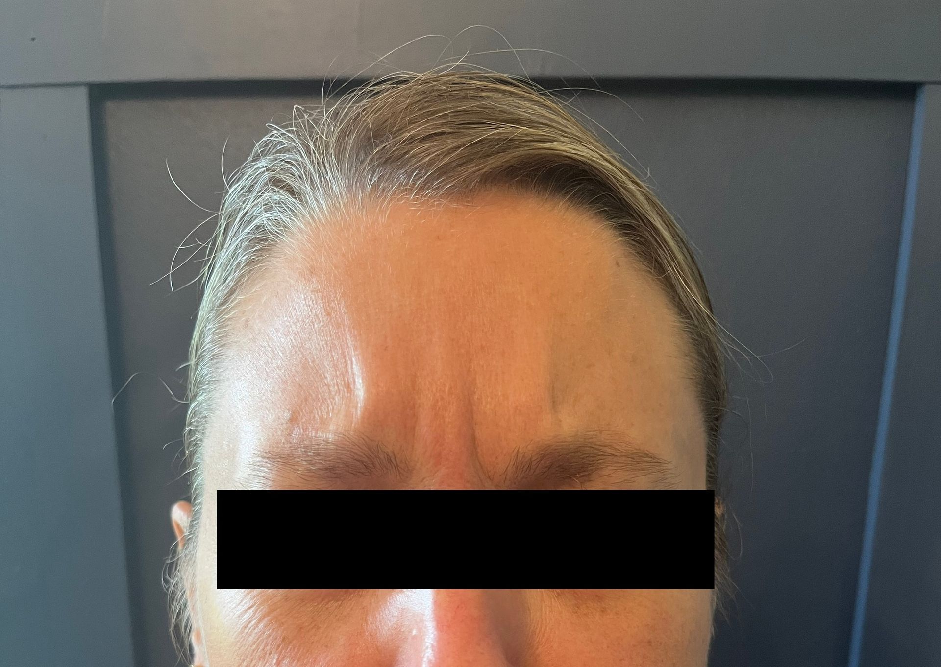 Close-up of a person's forehead with visible horizontal wrinkles and slight furrowing between the eyebrows.
