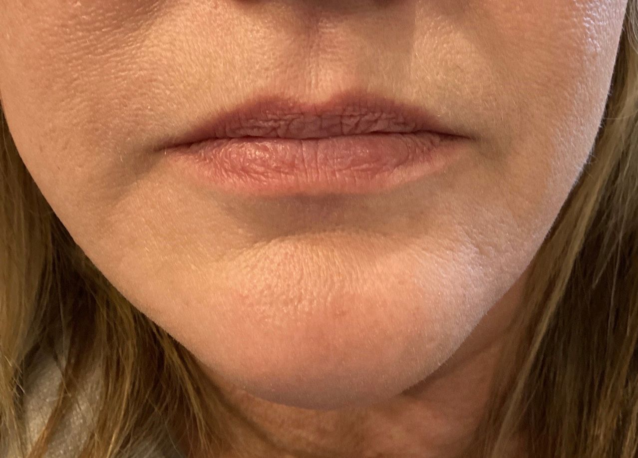 Close-up of a person's lower face, showing lips and chin. Skin is light-toned.