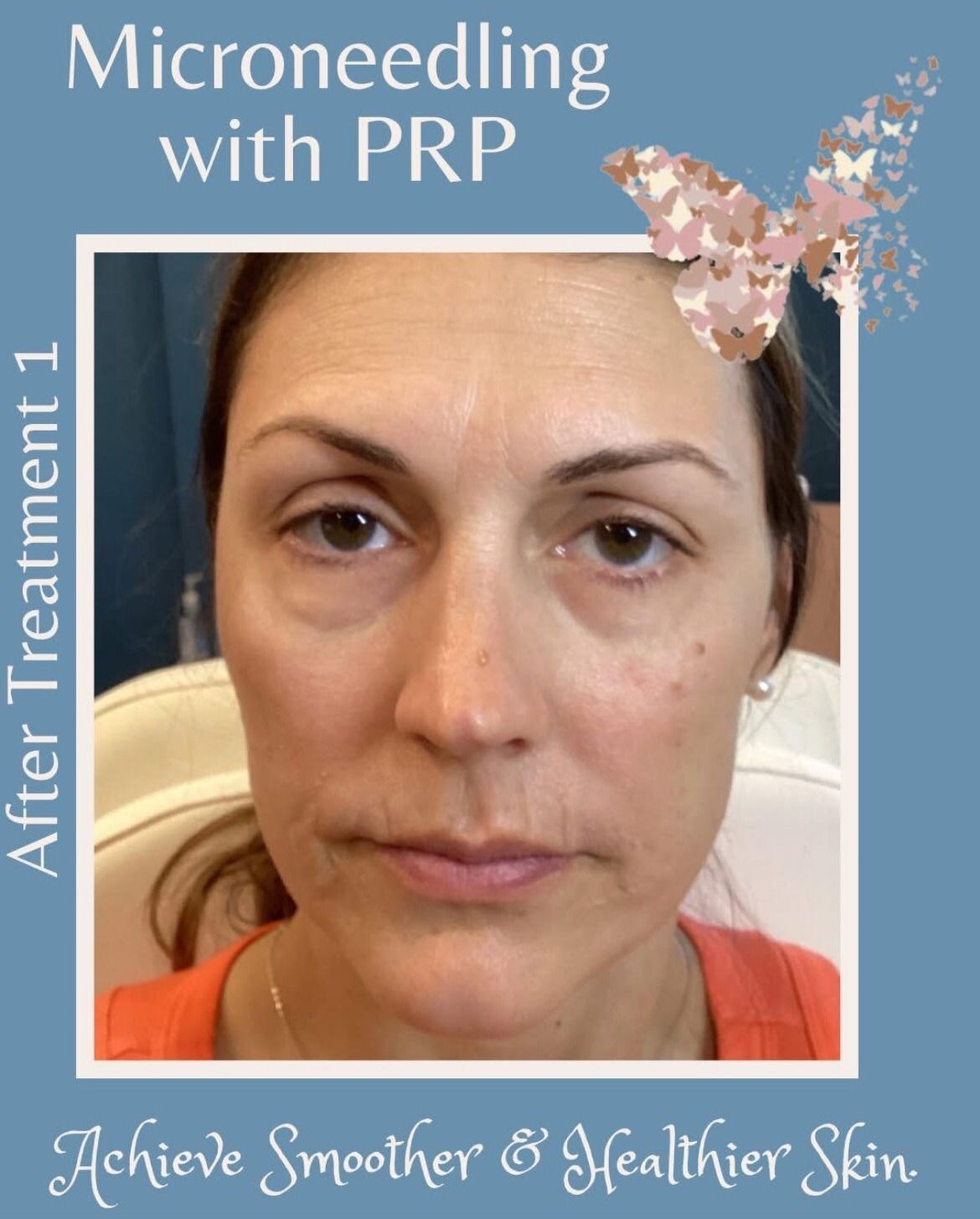 Woman's face after microneedling with PRP. Skin appears smoother, with text overlay, 