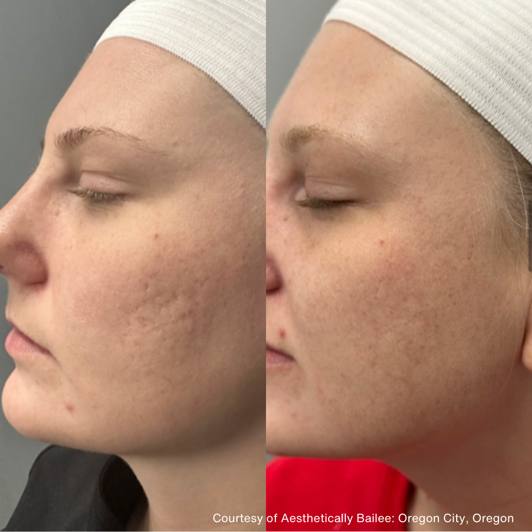 Before and after images of a person's cheek. Left side has deep acne scars; right side shows improved skin.