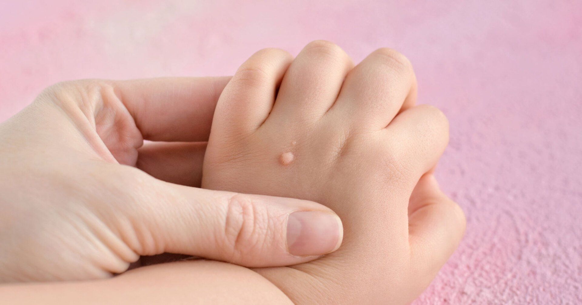 An adult hand holds a child's hand, which has a small, round skin bump on the back against a soft pink background.