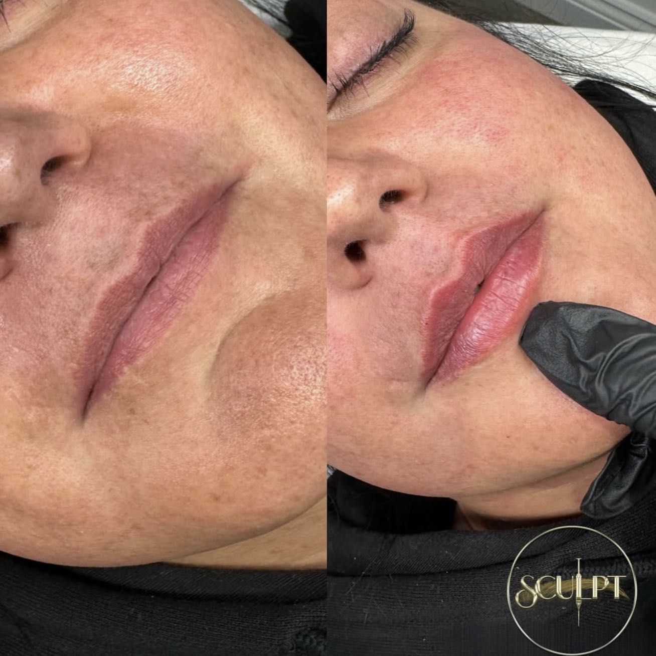 Rep Lips Lip Filler Treatments | Sculpt York | York