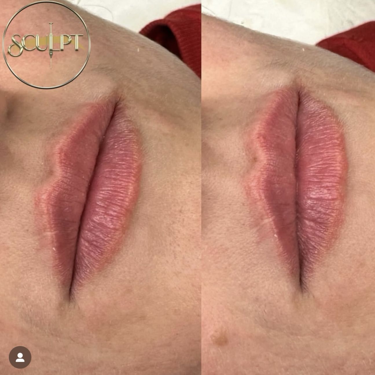 Rep Lips Lip Filler Treatments | Sculpt York | York
