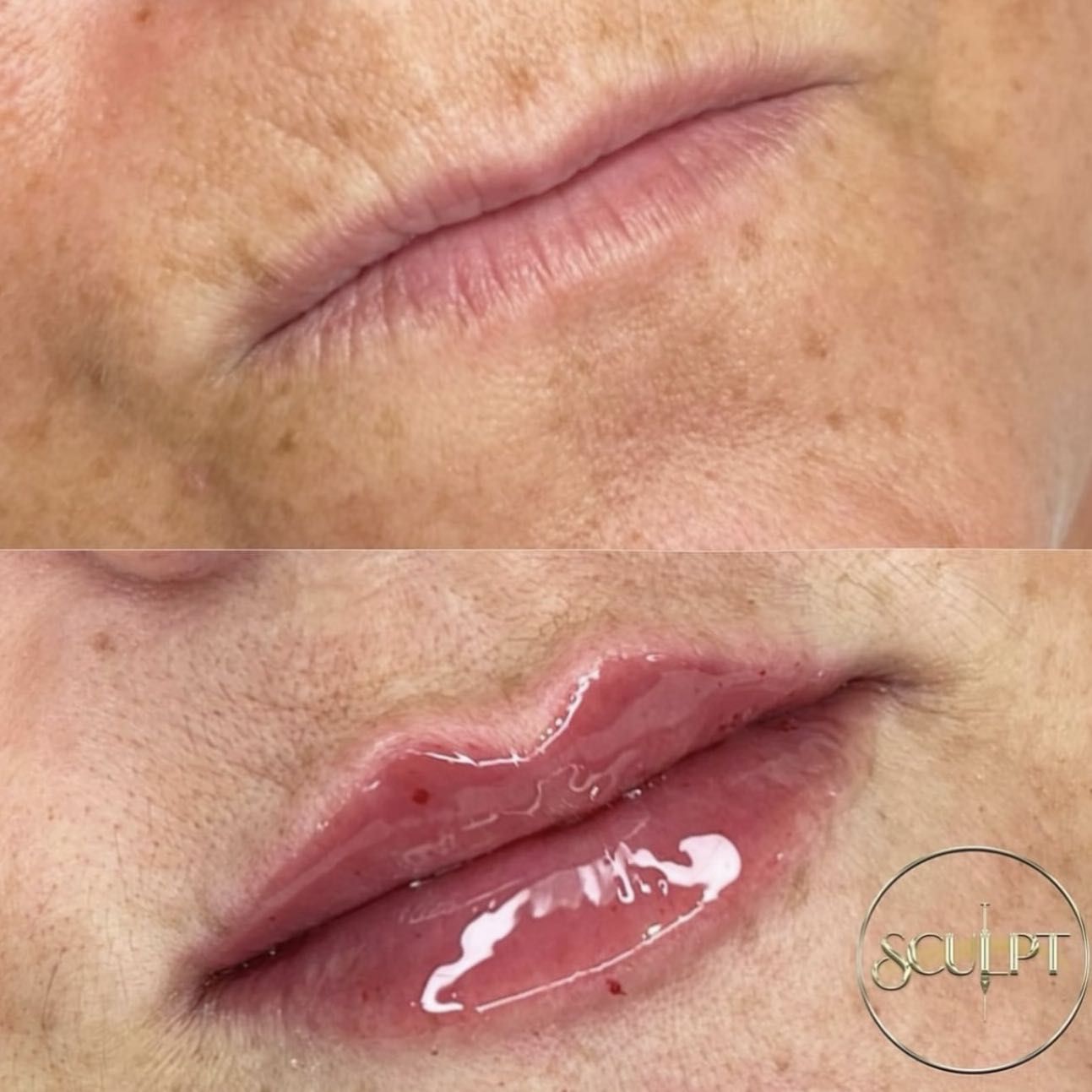 Rep Lips Lip Filler Treatments | Sculpt York | York