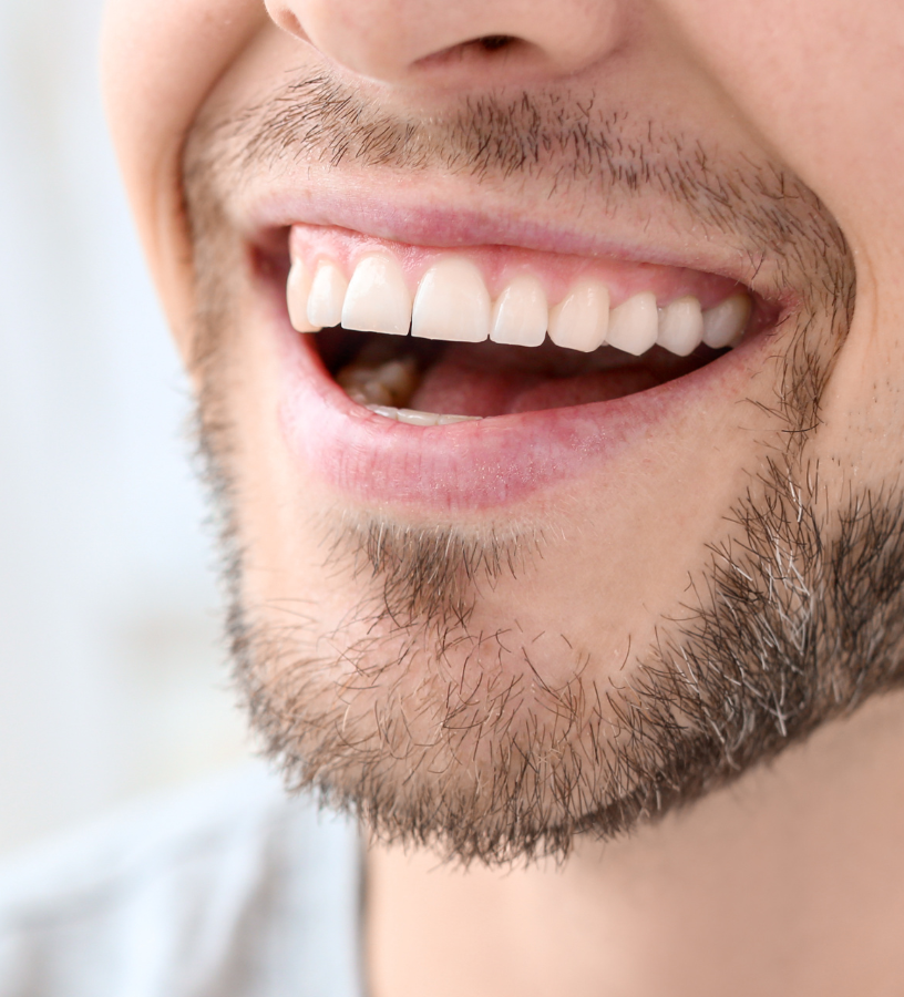 Homme souriant portant une barbe, dévoilant des dents blanches et éclatantes.