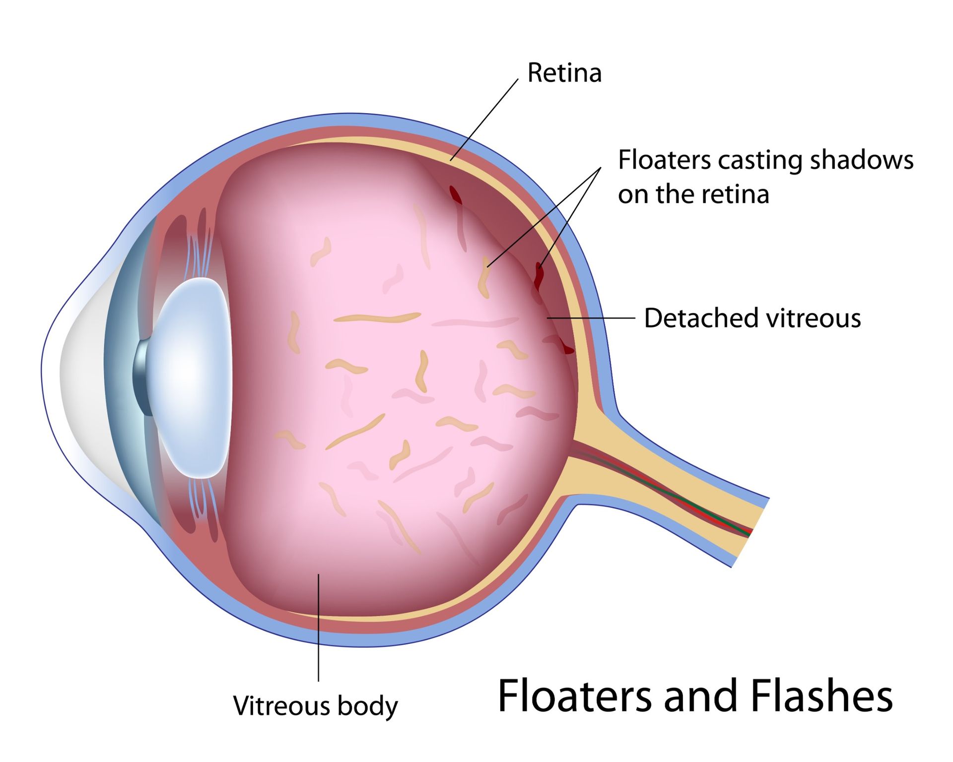 When Should I Worry About Eye Floaters?