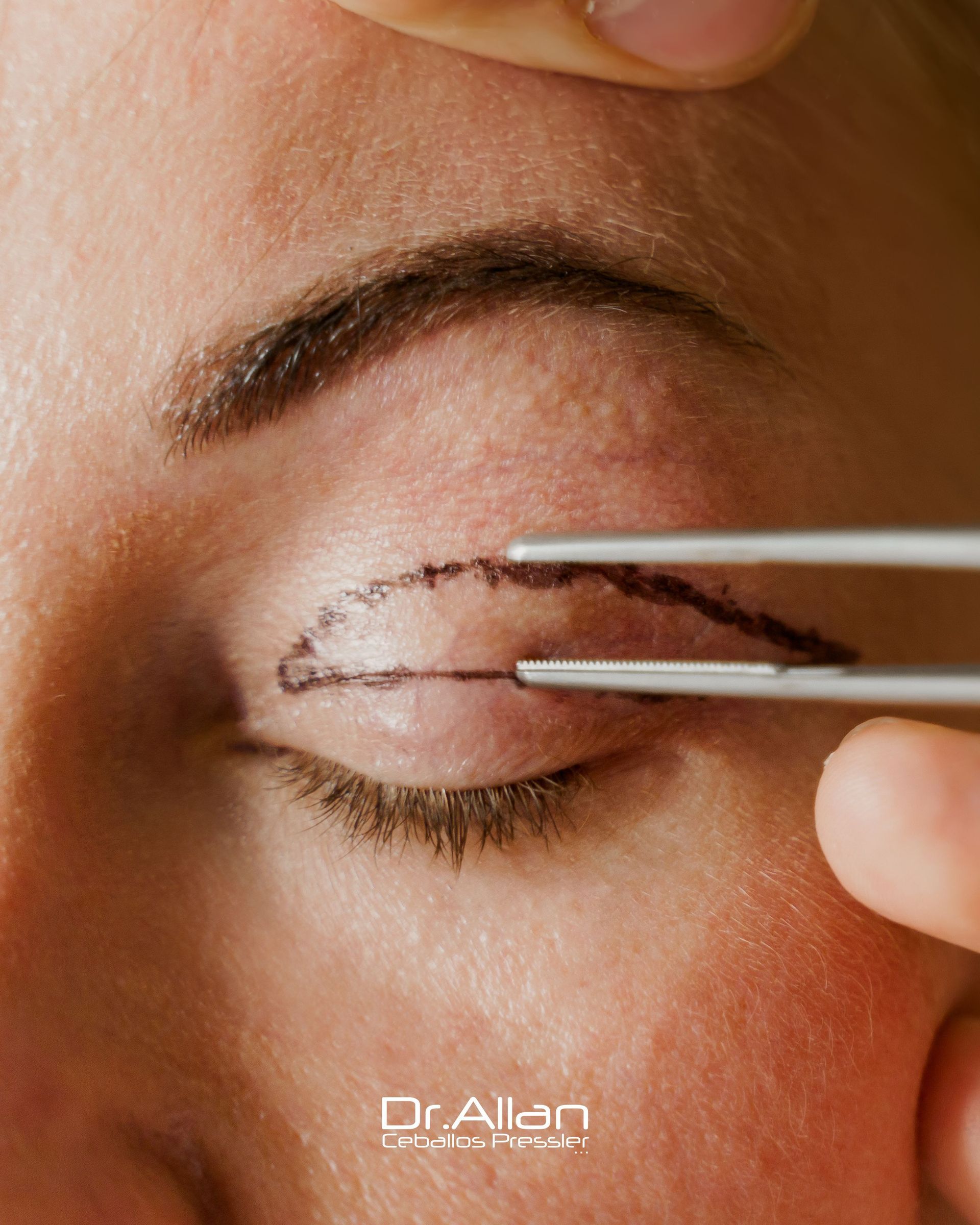 Pinzas para dar forma a una ceja con el ojo cerrado durante un tratamiento de belleza.