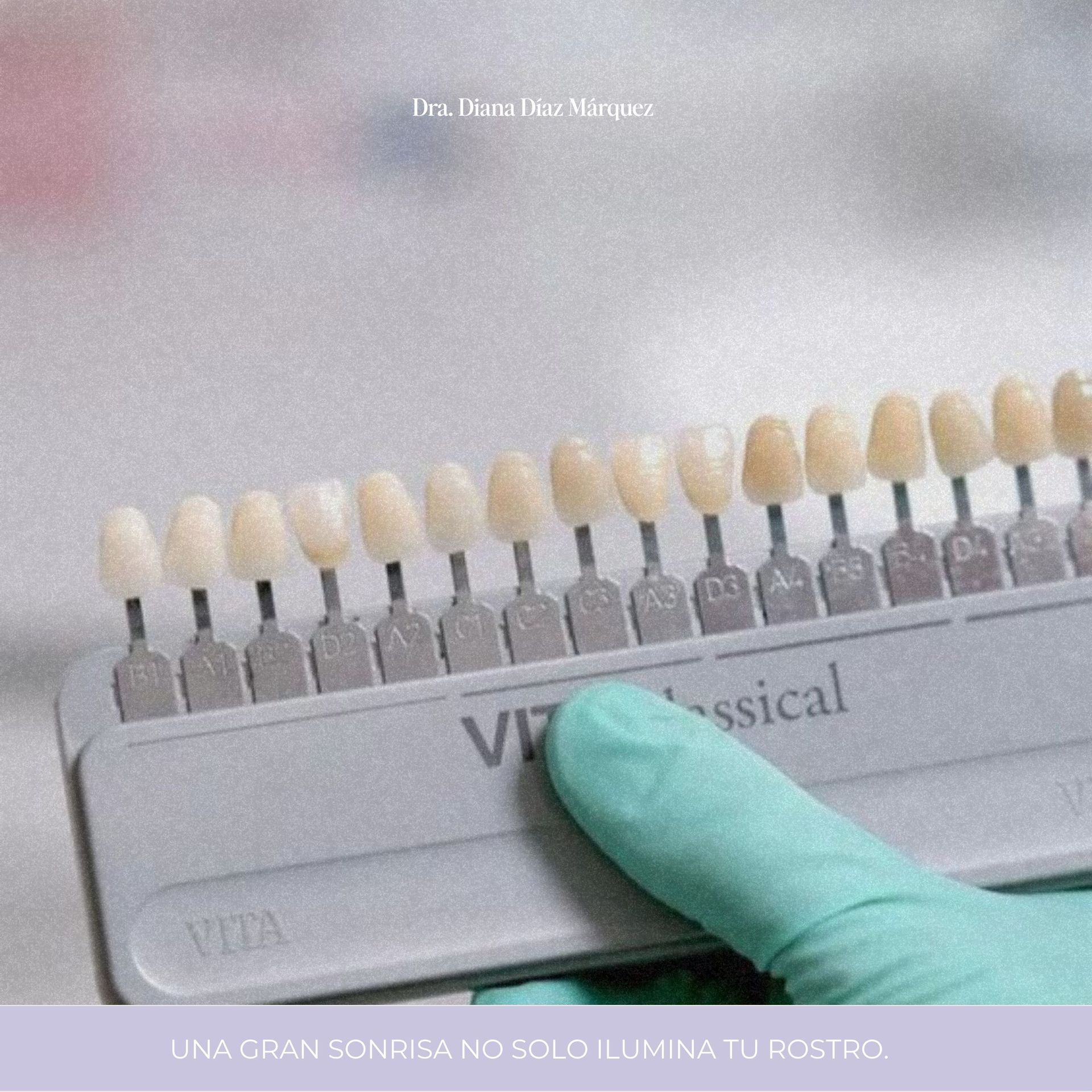 Guía de colores dentales con una mano enguantada seleccionando una muestra del color del diente en una ficha dental.
