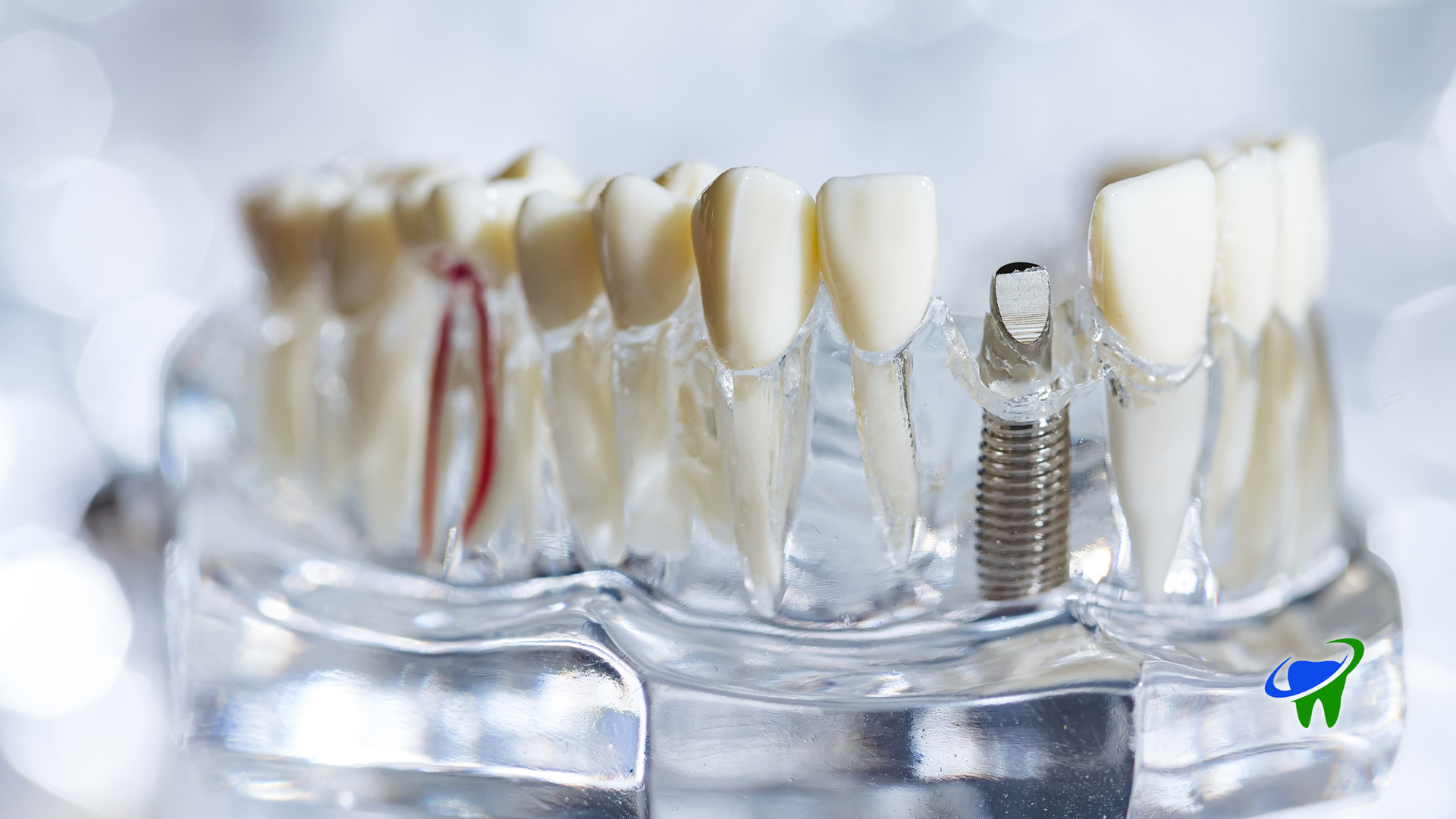 Dental implant model with artificial teeth and a metal implant on a clear base
