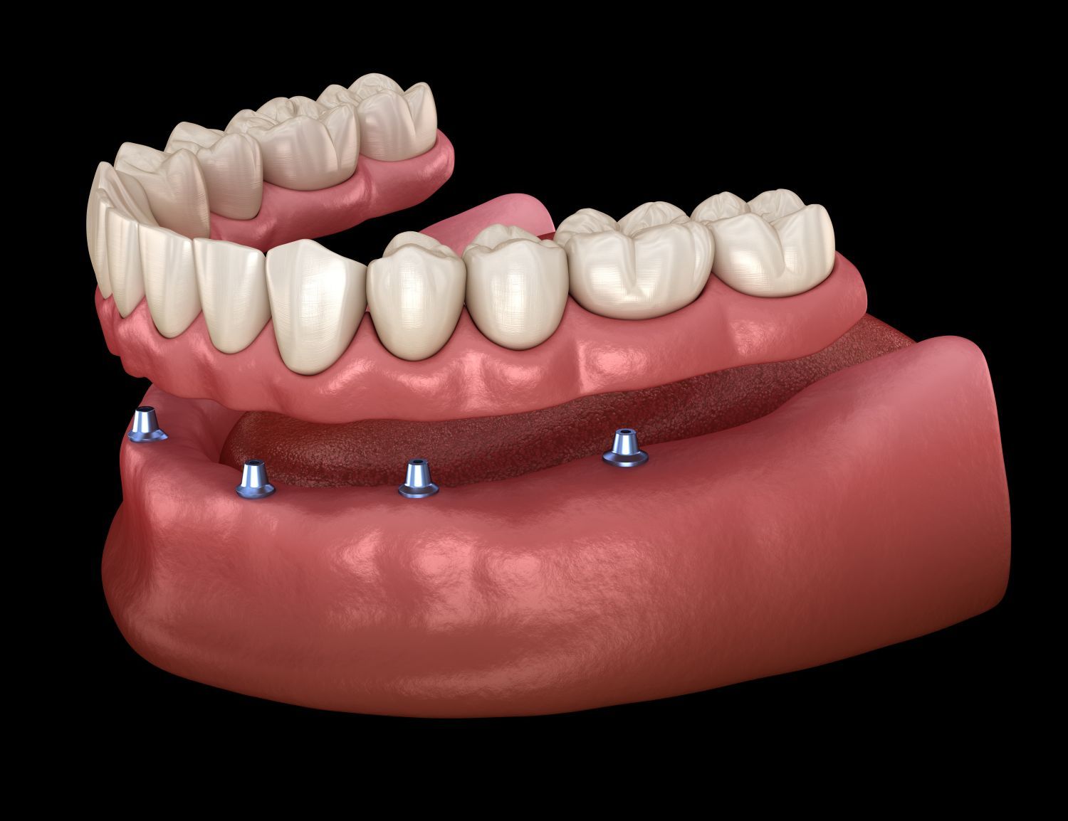 Dental implant model showing lower jaw with pink gums and white teeth supported by blue implants