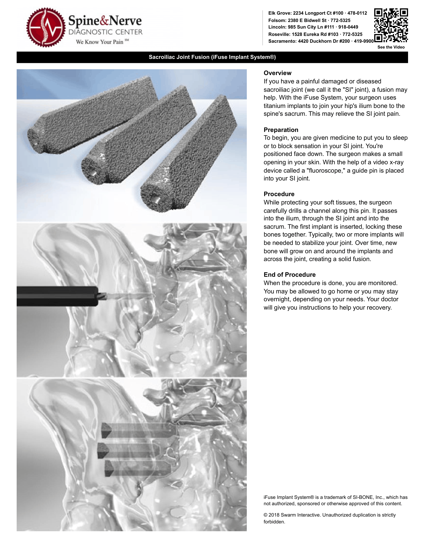 Sacroiliac Joint Fusion (iFuse Implant System)