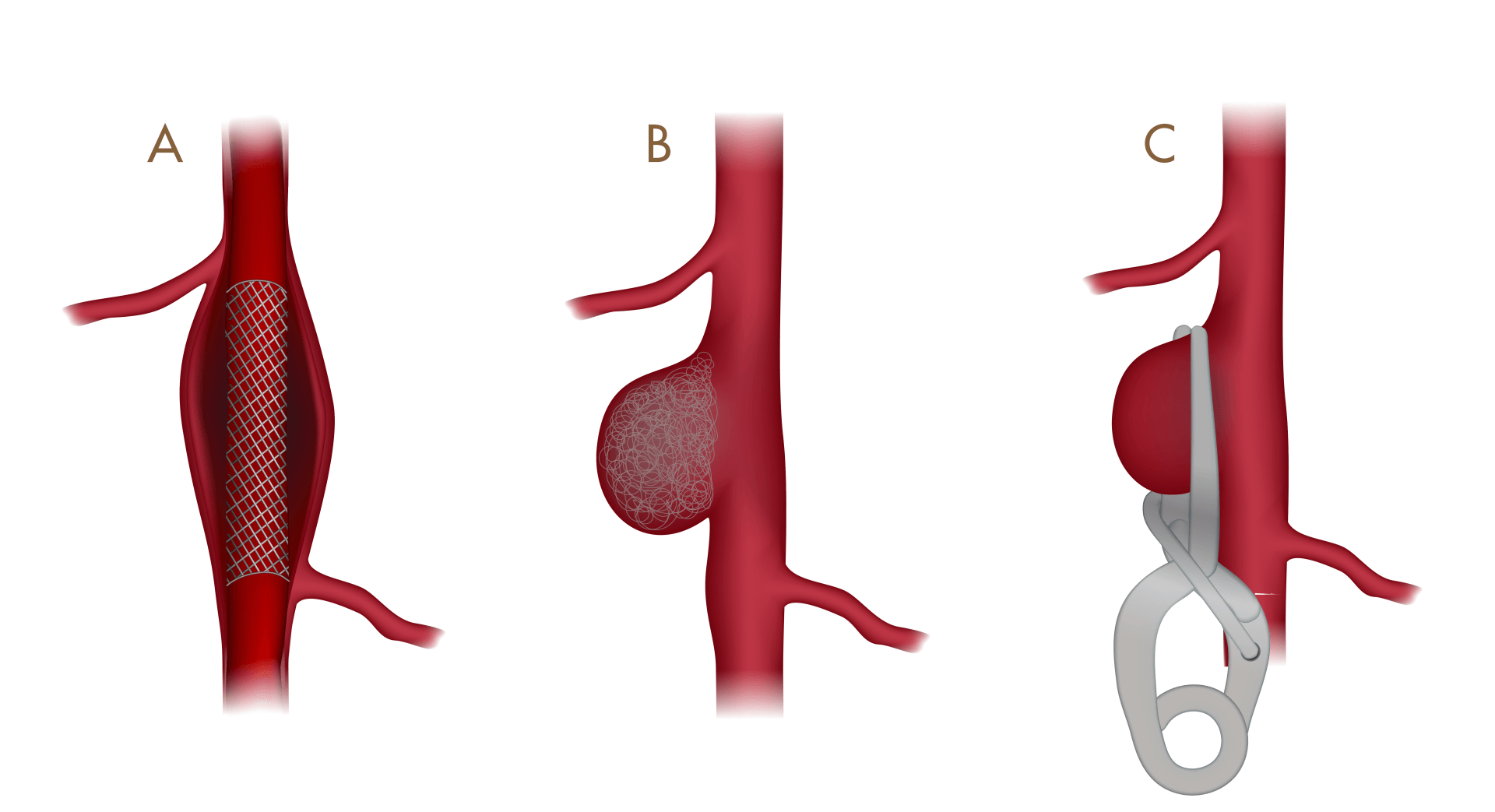 CLIPAGEM x EMBOLIZAÇÃO: Qual o melhor para aneurismas cerebrais