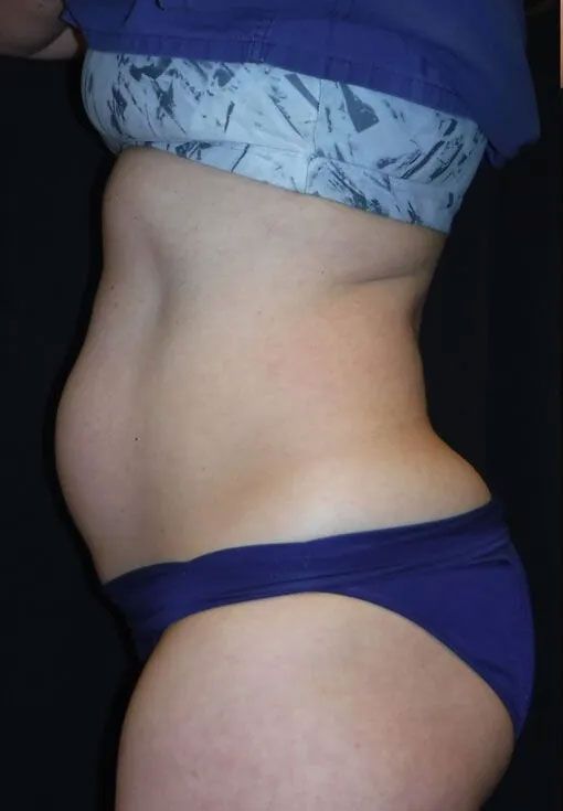 cellulite treatment before