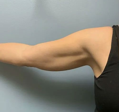 evolve sculpting arm before