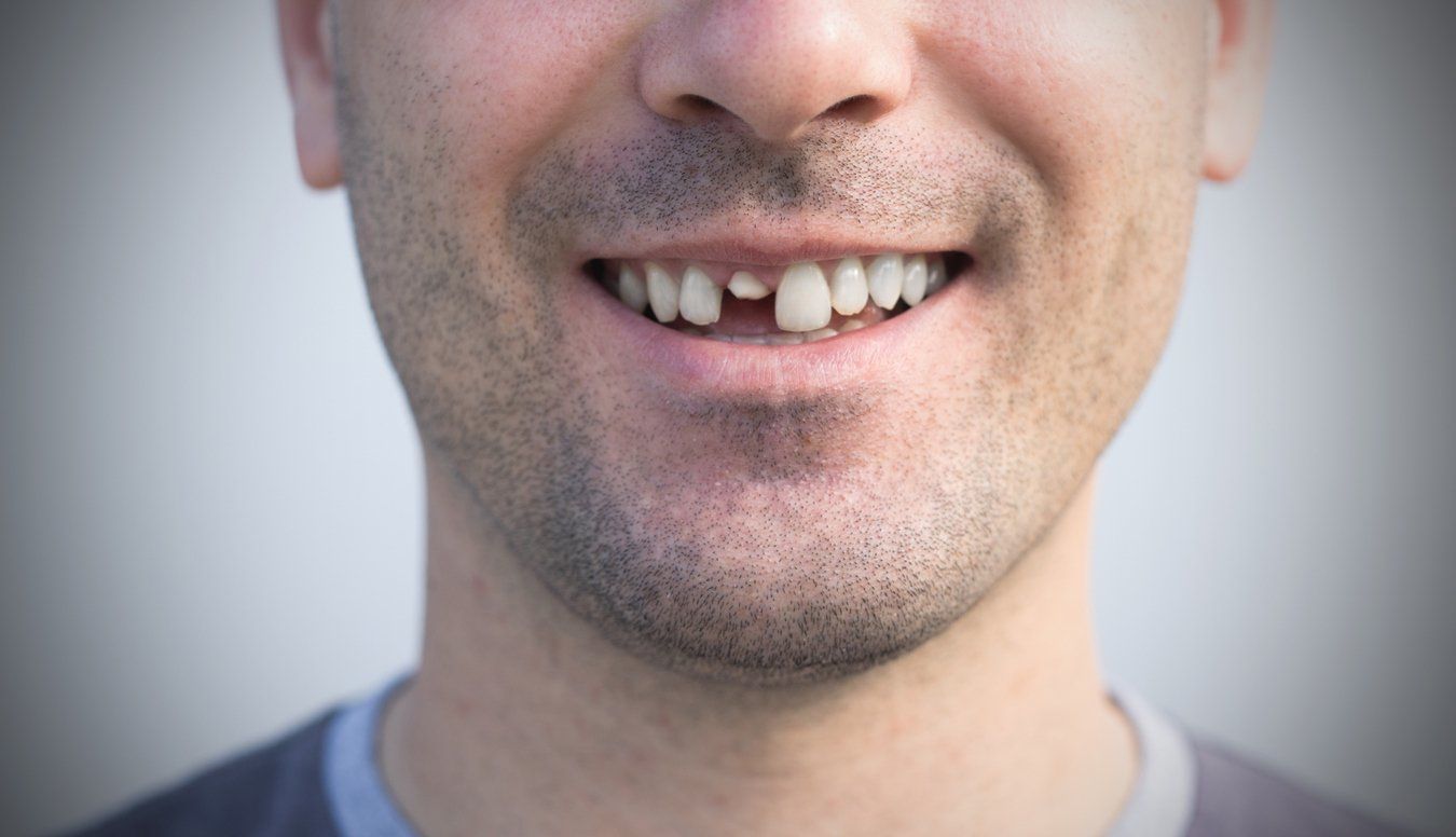 damaged teeth