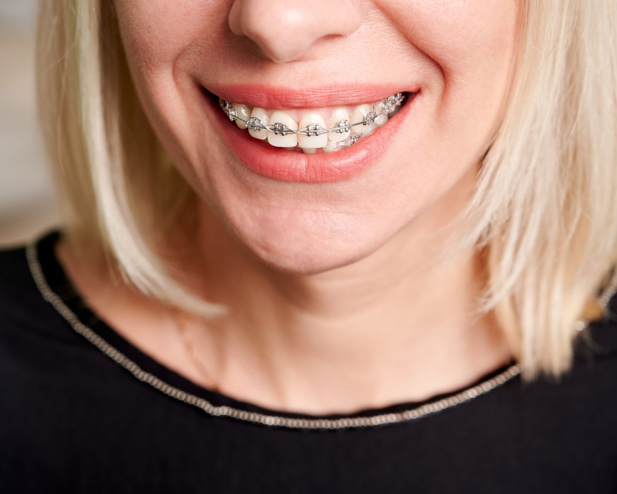 Woman with blonde hair smiling, showing metal braces on her teeth. She wears a black shirt.