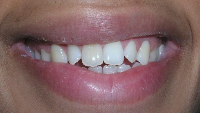 Close-up of a person's smiling mouth revealing teeth of varying sizes and a slightly crooked alignment.
