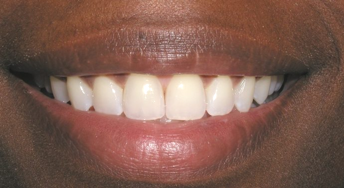 invisalign after, cosmetic dentistry