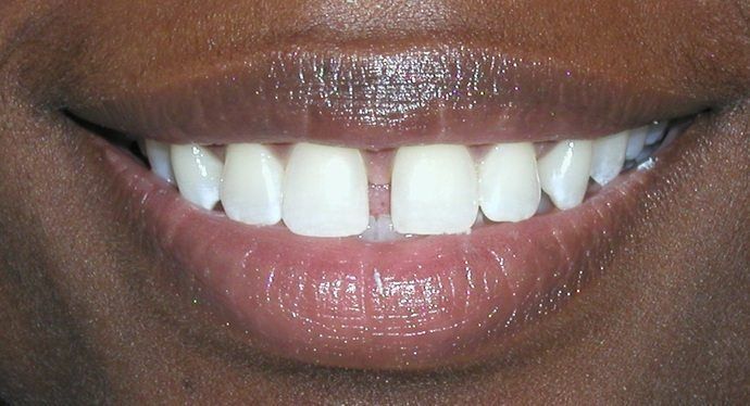 invisalign before, cosmetic dentistry