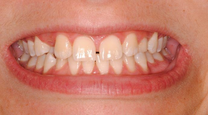 smile makeover before, cosmetic dentistry