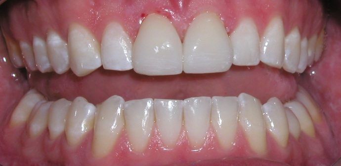 Close-up of a person's teeth. The top two front teeth are whiter than the other teeth. The gums are pink.