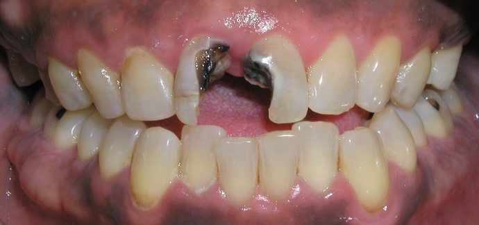 Close-up of a person's mouth, showing decayed and broken front teeth with discoloration. Other teeth appear yellowed.