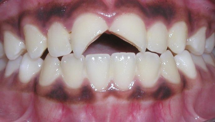 Close-up of a person's teeth, with a noticeable gap between the two front teeth. The teeth are slightly yellowed.
