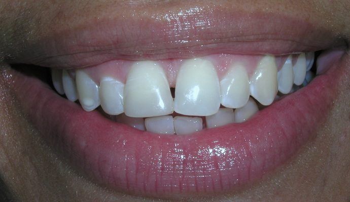 Close-up of a person's smile, showing teeth with a gap, pink gums, and glossy pink lips.