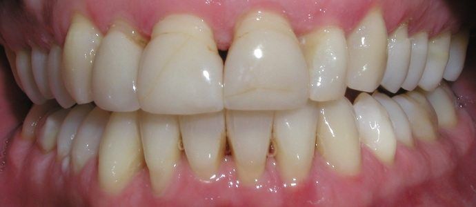 Close-up of teeth, showing the upper and lower arches, with yellowing and staining. The gums are pink, and the teeth are generally light-colored.