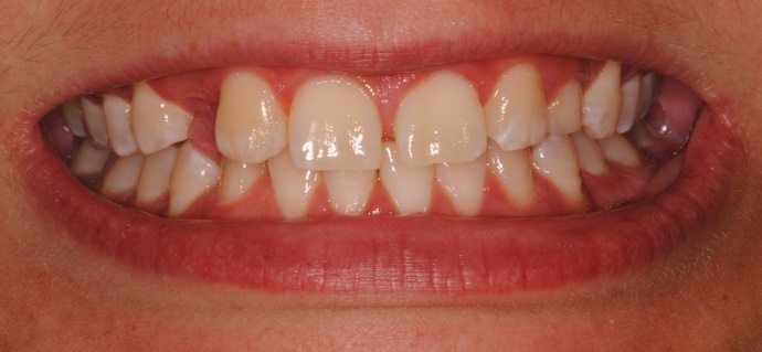 Close-up of a person's teeth, showing significant misalignment. Some teeth are visibly crooked, and there is an apparent gap between front teeth.
