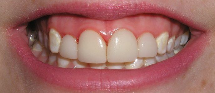 Close-up of a person's mouth, revealing a row of white teeth with pink gums and lips.