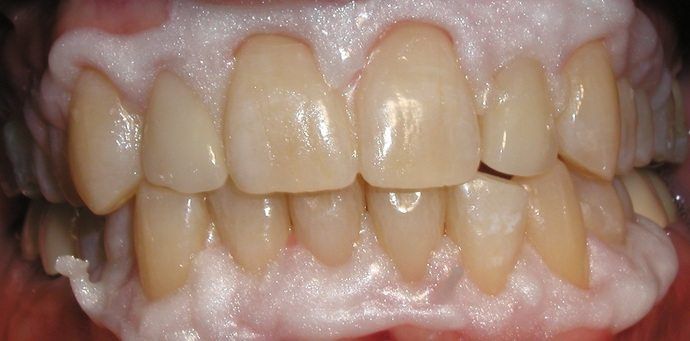 invisalign before, cosmetic dentistry