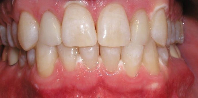 invisalign after, cosmetic dentistry