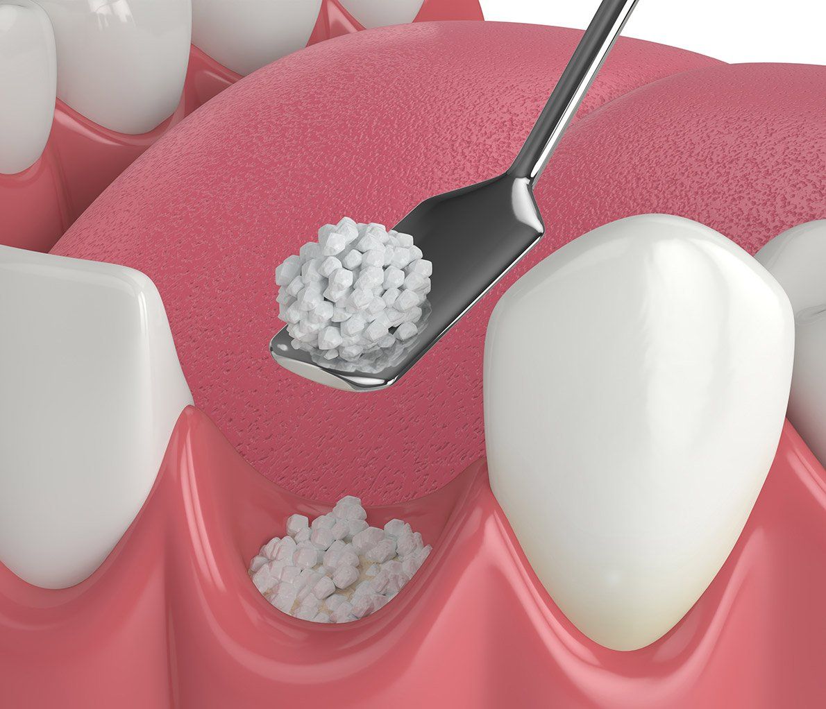 Bone Grafting in Owings Mills, MD