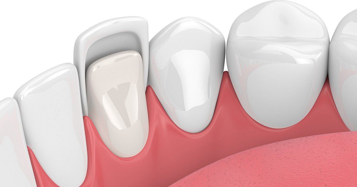 Porcelain Veneers, Dentist in Owings Mills MD