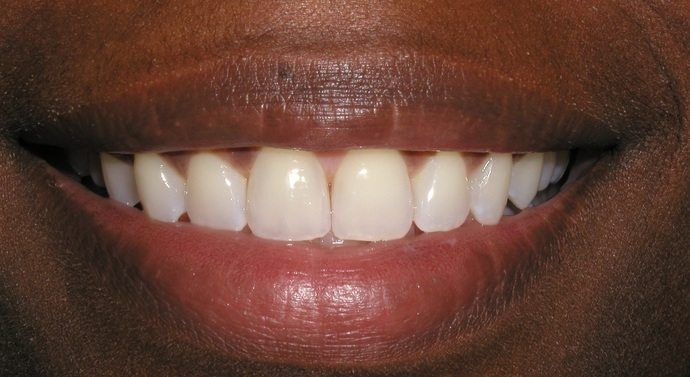 after fastbraces 2