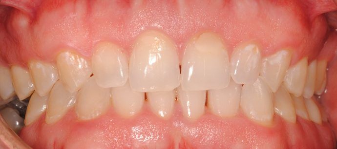 after fastbraces