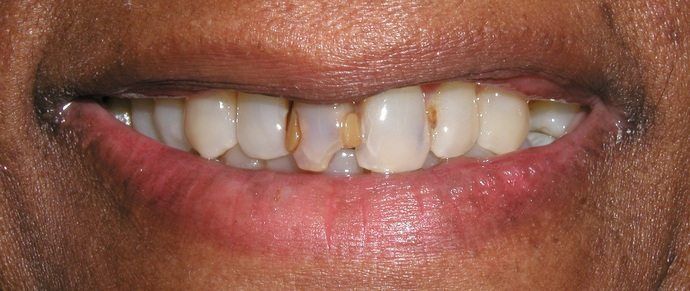 A person's smile displaying a mouth with yellowed and damaged teeth. The lips are full and red.