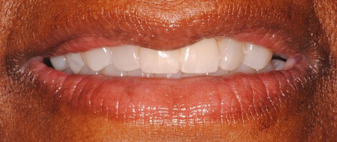 Close-up of a person's mouth showing a slight smile. The lips are dark and glossy, with bright white teeth.