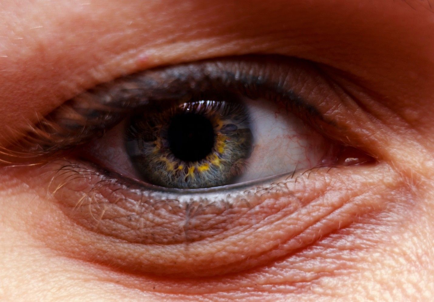 Dry Eye Syndrome: Why It’s More Common Than You Think