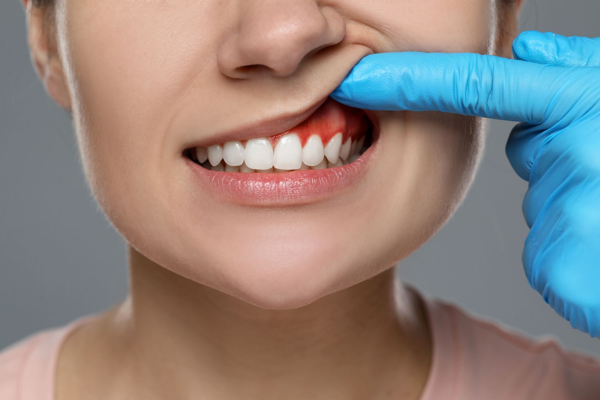 Person with inflamed gums, finger in blue glove pointing at red, swollen tissue near teeth.